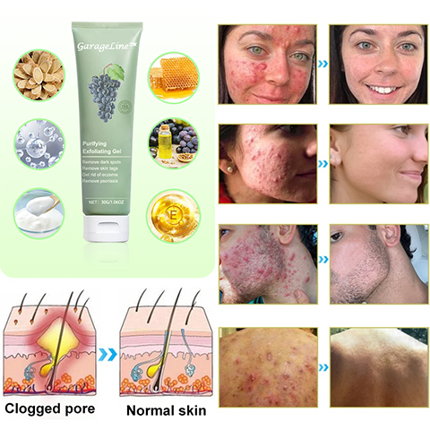 GarageLine™ Exfoliating Gel【🍇Treats Acanthosis Nigricans, Exfoliates, Fades Dark Spots🍇】