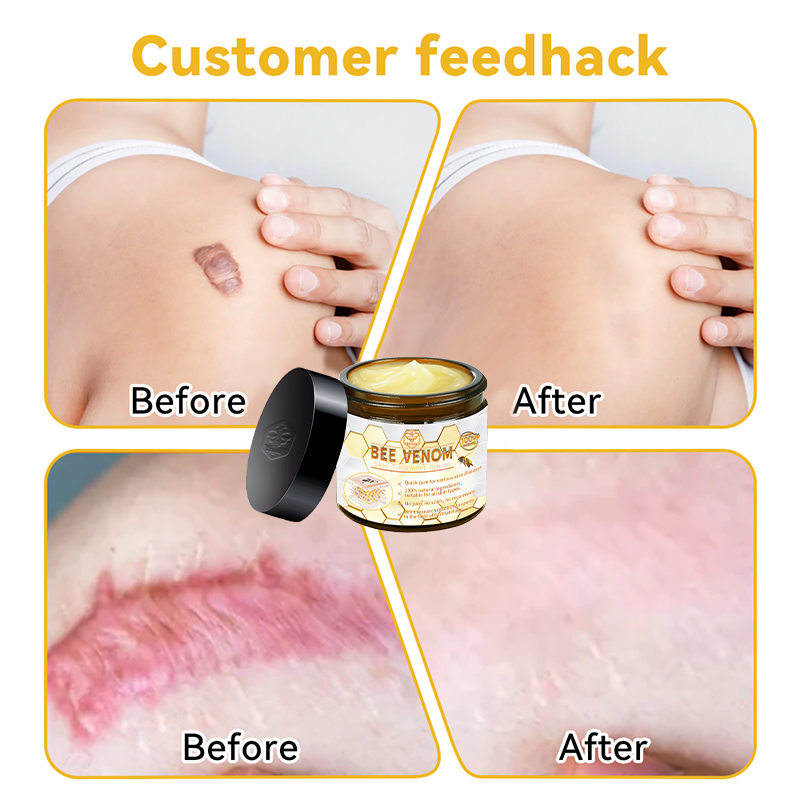 Turonu Bee Venom Skin Treatment CreamοΌπ»πΌπ΄π· π
πππππππππππ»οΌ