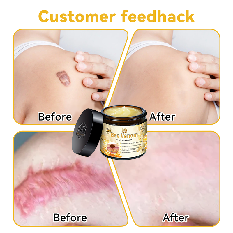 Christmas Sale 🤶🏻Turonu™ Bee Venom Treatment Cream🐝(🎄𝐼𝐴𝐷 𝑅𝑒𝑐𝑜𝑚𝑚𝑒𝑛𝑑𝑒𝑑)