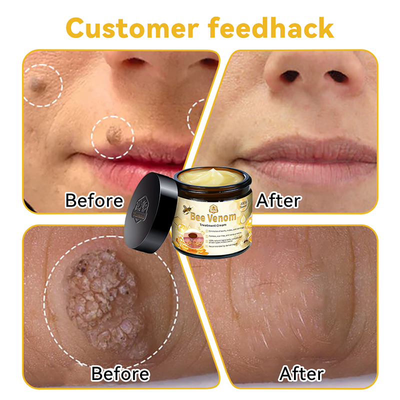 Christmas Sale 🤶🏻Turonu™ Bee Venom Treatment Cream🐝(🎄𝐼𝐴𝐷 𝑅𝑒𝑐𝑜𝑚𝑚𝑒𝑛𝑑𝑒𝑑)